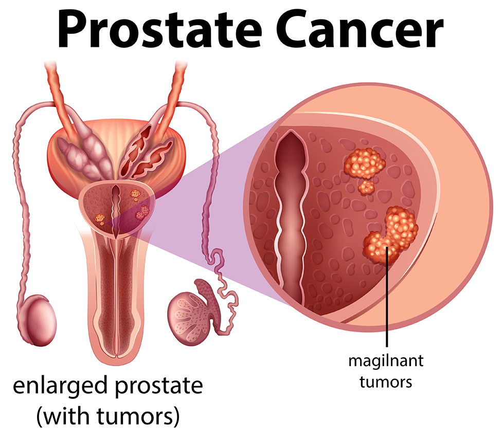1. prostate cancer adobestock 212335054 08810e6a