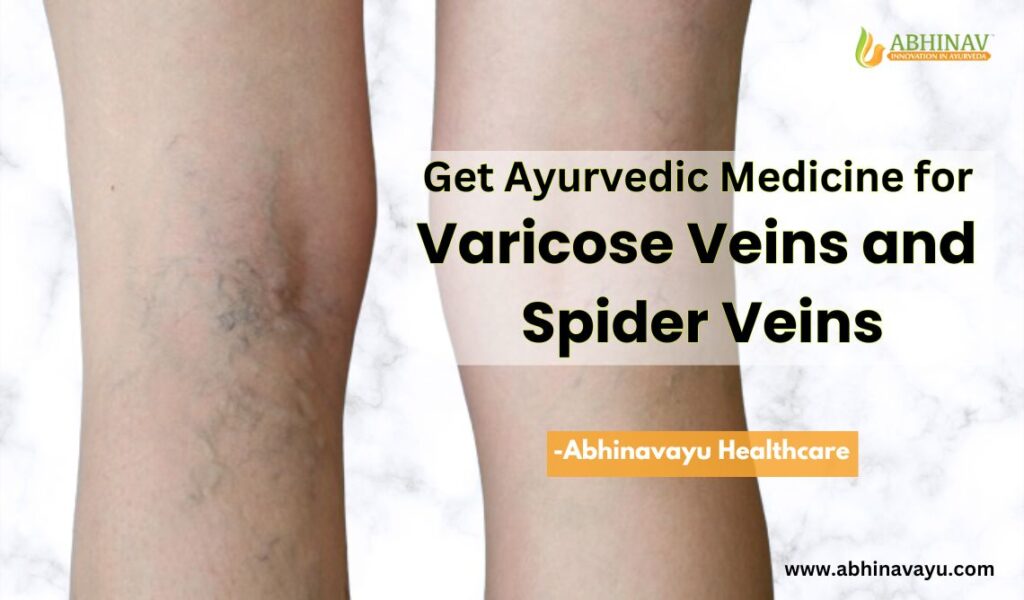 ayurvedic medicine for varicose veins and spider veins 4ed20d03