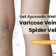 Get Ayurvedic Medicine for Varicose Veins and Spider Veins