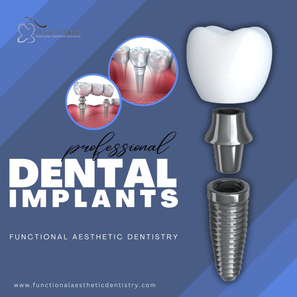 dental implants 1 43235585