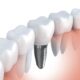 Best Quality Dental Implants in India