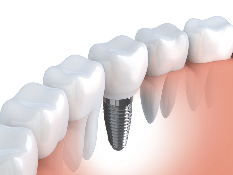 dentalimplants in india ac205d71