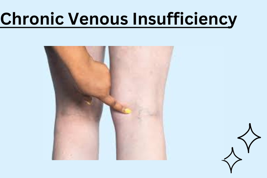 chronic venous insufficiency 4c30a438