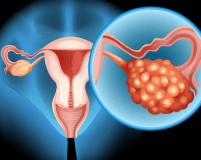Ovarian-Cancer